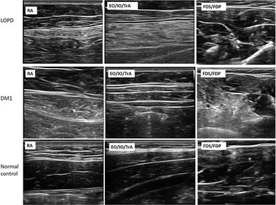 Ultrasonography of abdominal muscles: Differential diagnosis of late-onset Pompe disease and myotonic dystrophy type 1